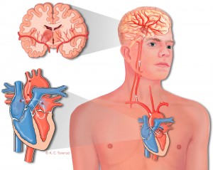 Stroke illustration